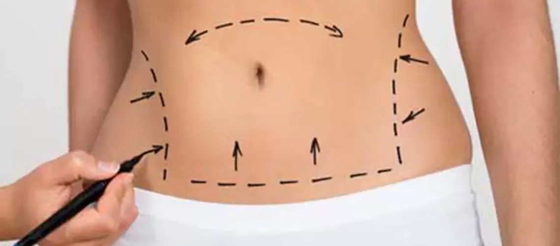 ابدومینوپلاستی