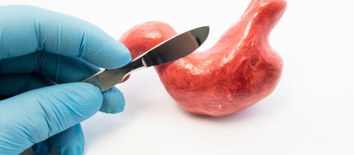 عمل بای پس معده