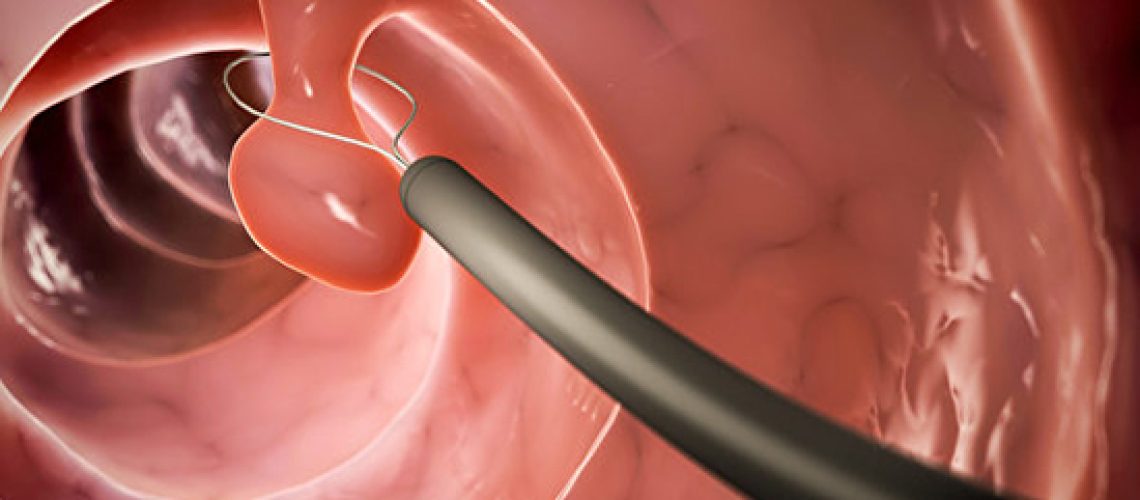 پولیپکتومی