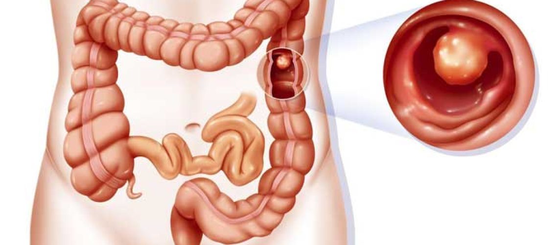 چسبندگی شکم