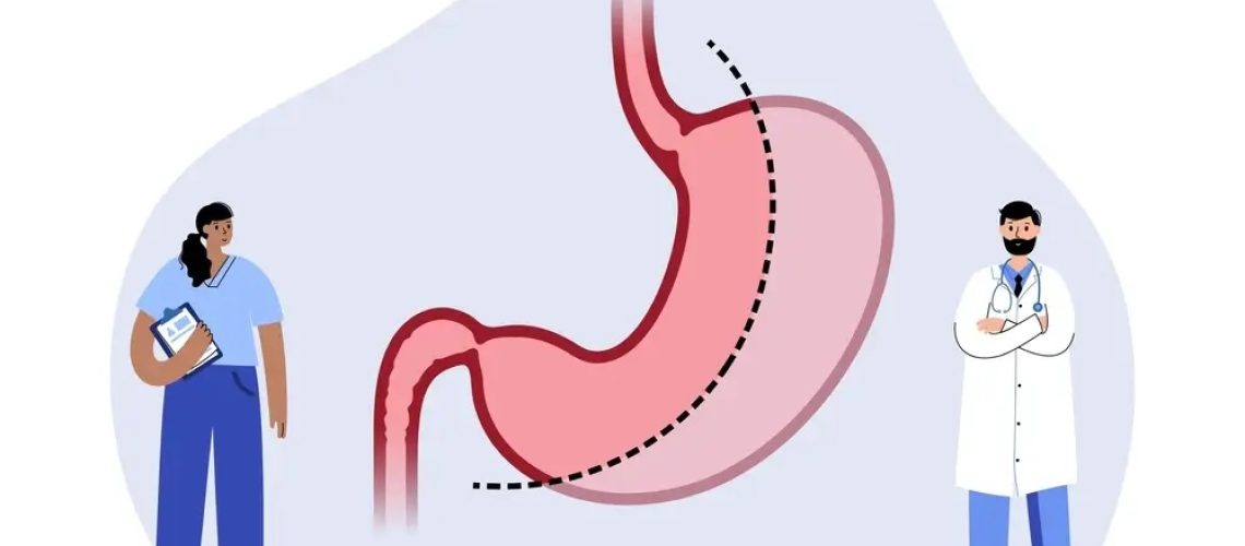 گاسترکتومی